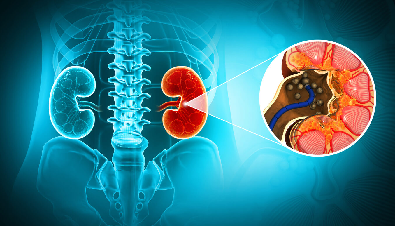 Renal Stone Disease